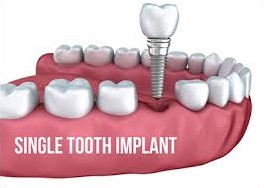 Implantology