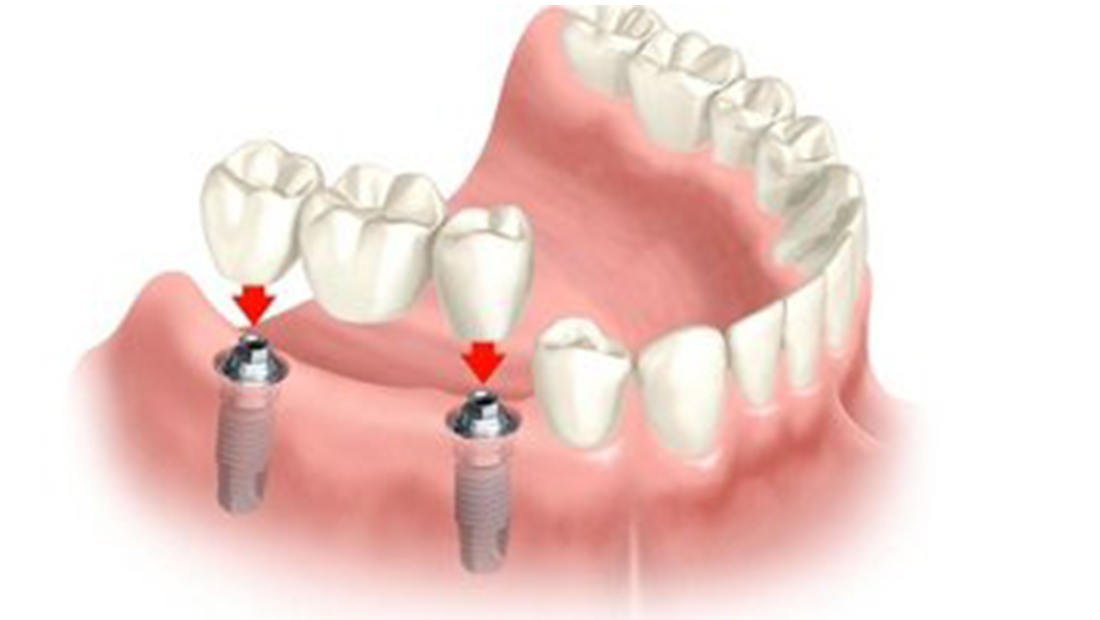 Implantology