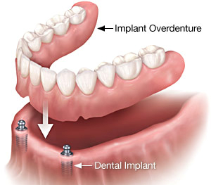 Implantology