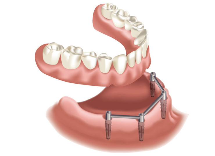 Implantology